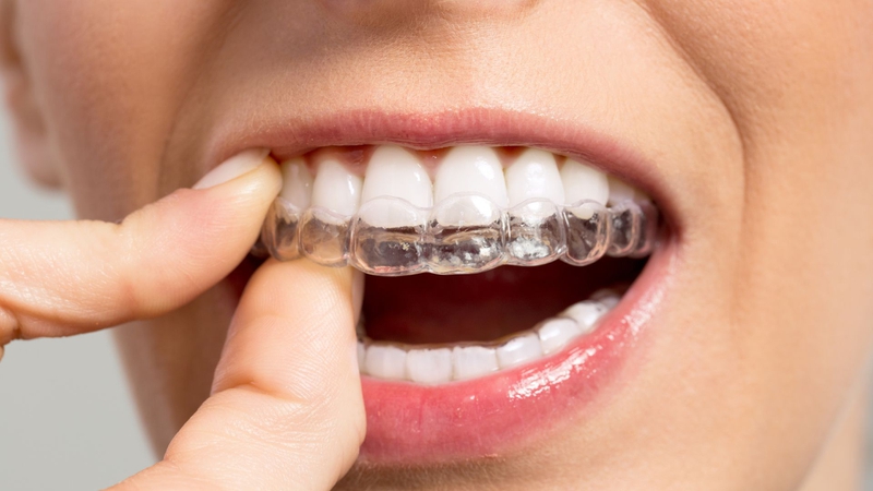 Kỹ thuật niềng răng vô hình là gì? Có hiệu quả không? 4