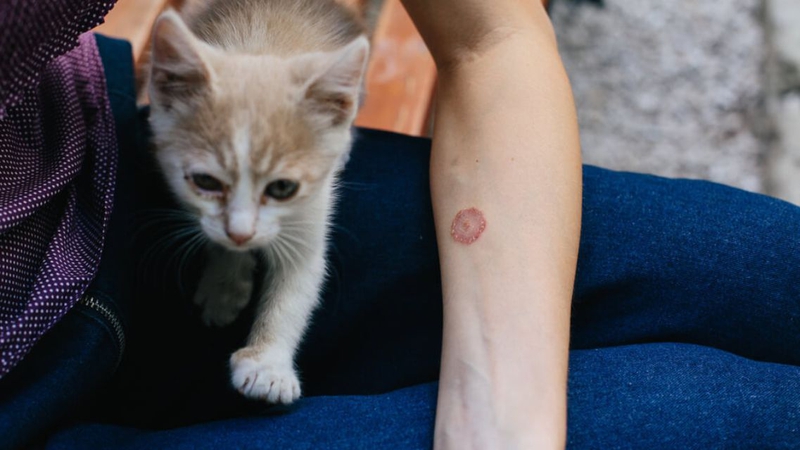 Lác đồng tiền có thể tái phát nếu không phòng ngừa đúng cách