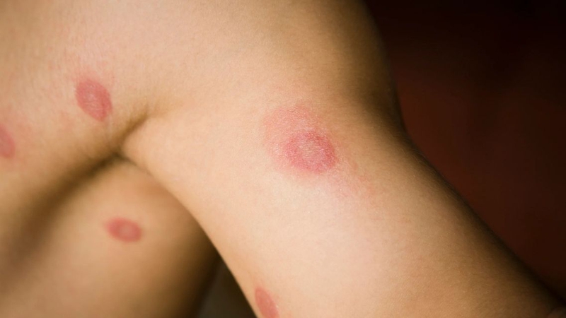 Bệnh lác đồng tiền do nấm gây ra, dễ lây lan và tái phát