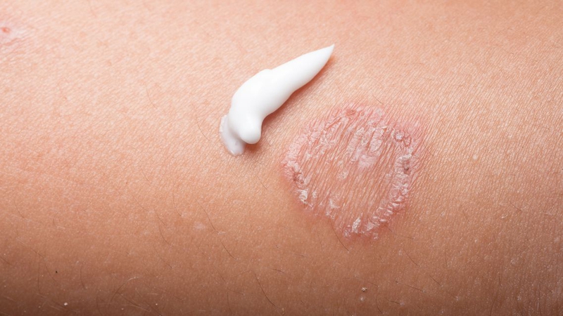 Lác đồng tiền cần được điều trị bằng thuốc phù hợp