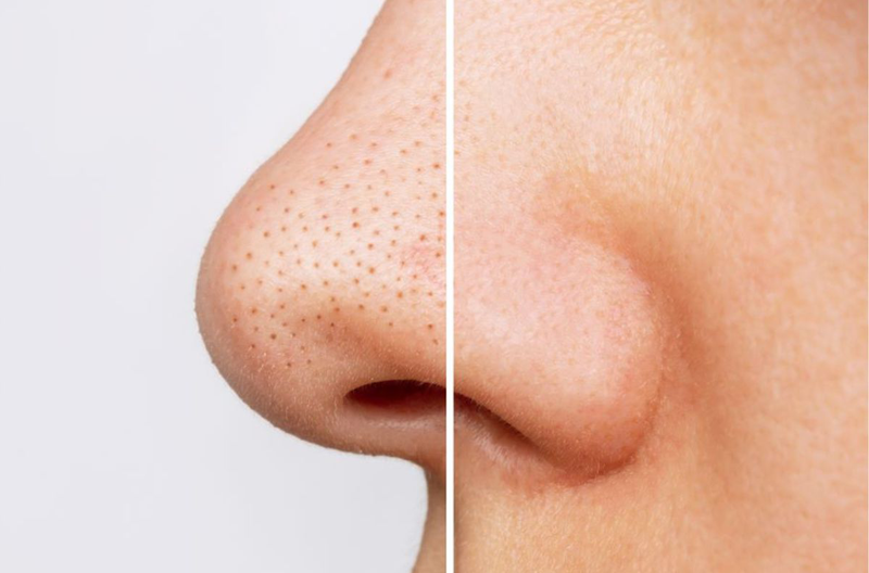 Làm sạch sâu da mặt có lợi ích gì? Cách làm sạch sâu da mặt 2