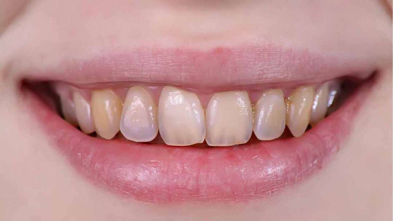 Tình trạng răng bị mảng bám vàng do đâu? 1