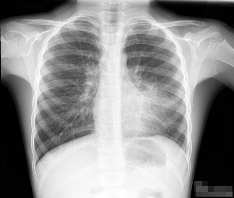 Cách lập kế hoạch chăm sóc bệnh nhân viêm phổi như thế nào? 3