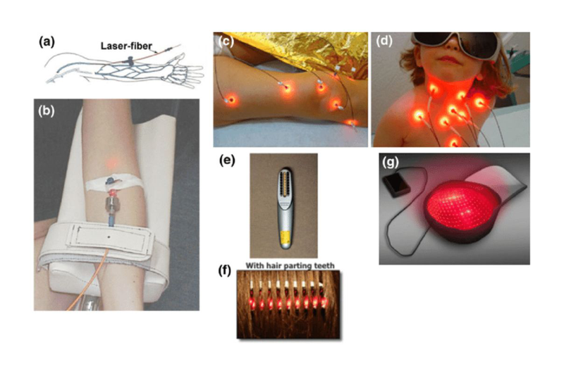 Phương pháp laser nội mạch là gì và có ưu điểm gì 1