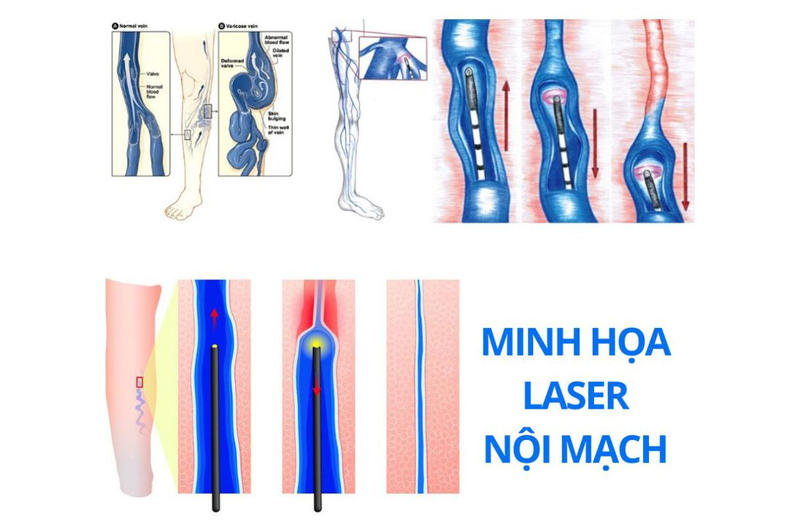 Phương pháp laser nội mạch là gì và có ưu điểm gì 2