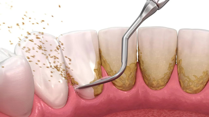 Lấy cao răng có hết hôi miệng không? Quy trình thực hiện 1