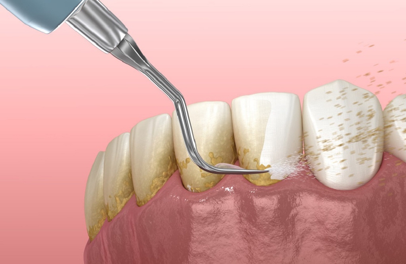 Lấy cao răng có tốt không? Tác dụng phụ khi lấy cao răng 2