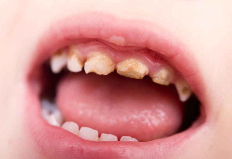 Lấy cao răng là gì? Tại sao phải lấy cao răng định kỳ? 1