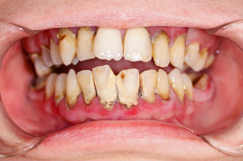 Lấy cao răng là gì? Tại sao phải lấy cao răng định kỳ? 2