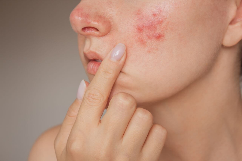 Mụn trên da có thể do tích tụ tế bào chết lâu ngày kết hợp bã nhờn và vi khuẩn hình thành