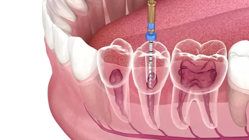 Lấy tủy răng mất bao lâu? Cách chăm sóc răng sau khi lấy tủy 4