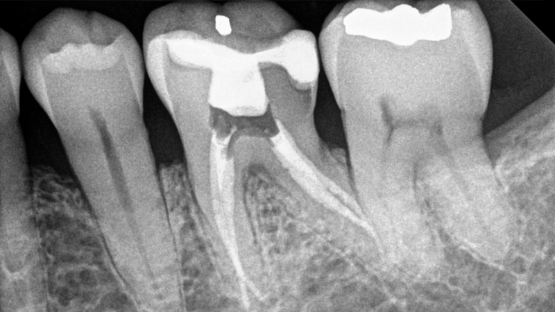 Lấy tủy răng mấy lần mới xong và quy trình lấy tủy răng nhiều lần 2