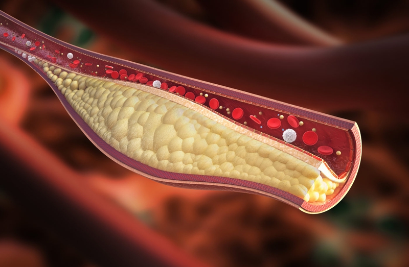 LDL Cholesterol cao cảnh báo bệnh gì? 1