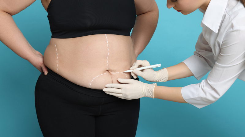 Liệu hút mỡ bụng xong có đau không? Cách chăm sóc sau khi hút mỡ bụng 2