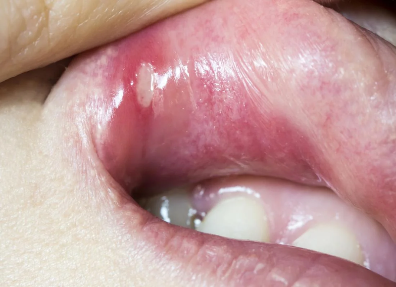 Lở miệng ở môi kéo dài có nguy hiểm không? 5 giai đoạn của bệnh cần lưu ý 1