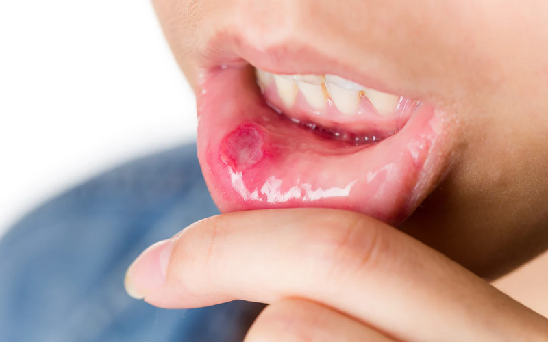 Lở miệng ở môi kéo dài có nguy hiểm không? 5 giai đoạn của bệnh cần lưu ý 3