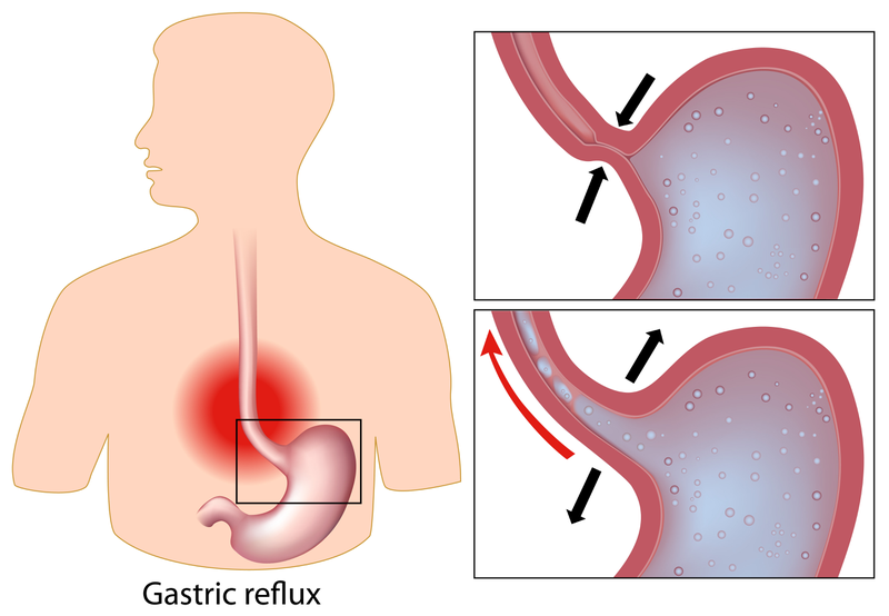 Loét thực quản là gì? Những vấn đề cần biết về loét thực quản 2.jpg