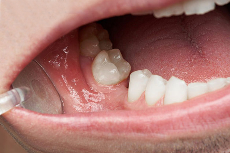 Lợi thừa ở răng hàm phải làm sao?