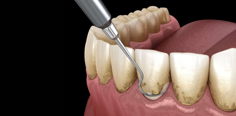 Lợi thừa ở răng hàm phải làm sao?