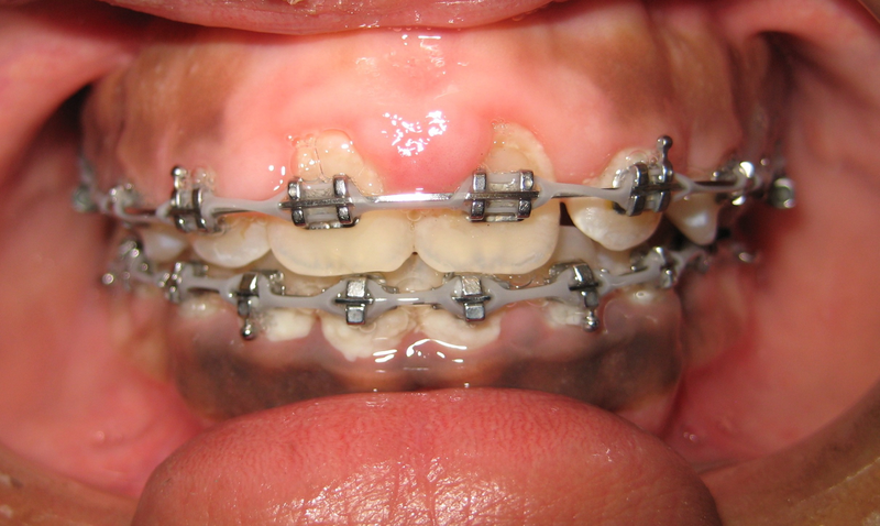 Lợi trùm khi niềng răng: Nguyên nhân, triệu chứng, cách khắc phục 1