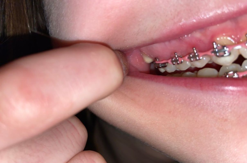 Lợi trùm khi niềng răng: Nguyên nhân, triệu chứng, cách khắc phục 2