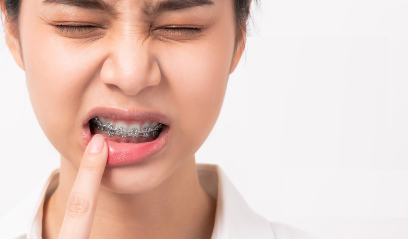 Lợi trùm khi niềng răng: Nguyên nhân, triệu chứng, cách khắc phục 3