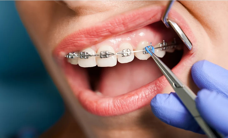 Lợi trùm khi niềng răng: Nguyên nhân, triệu chứng, cách khắc phục 4