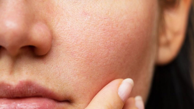 Da khô thiếu ẩm dễ bị mốc nền khi trang điểm