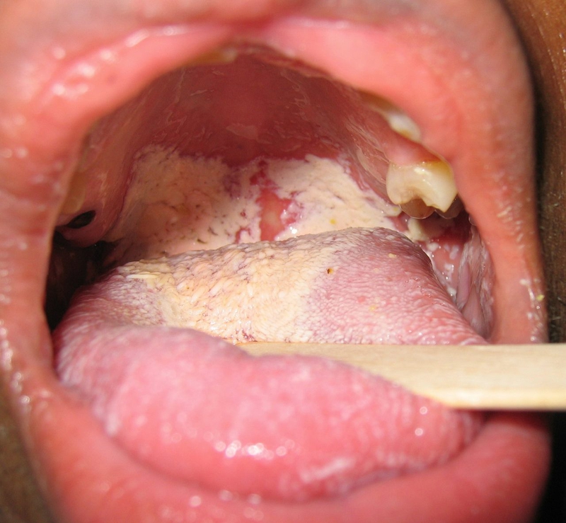 Nấm miệng là một trong những bệnh thường gặp về lưỡi