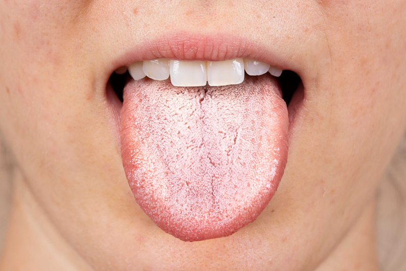 Lưỡi trắng là bệnh gì? Có nguy hiểm không? 1