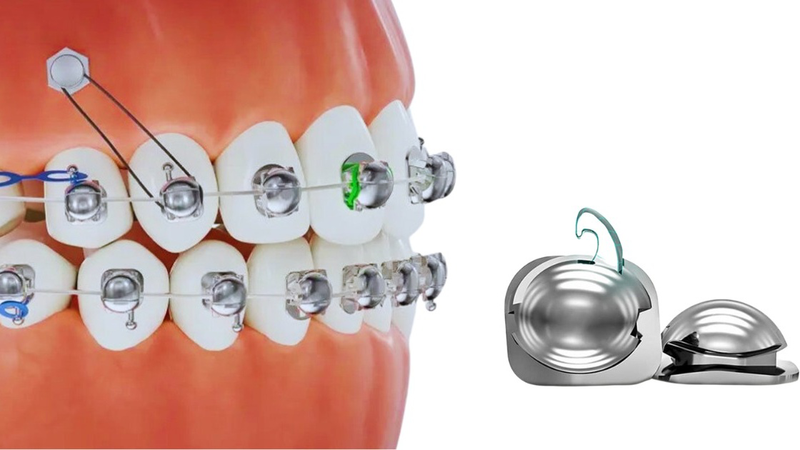 Mắc cài cánh cam: Giải pháp niềng răng thẩm mỹ và những ưu nhược điểm cần biết 1