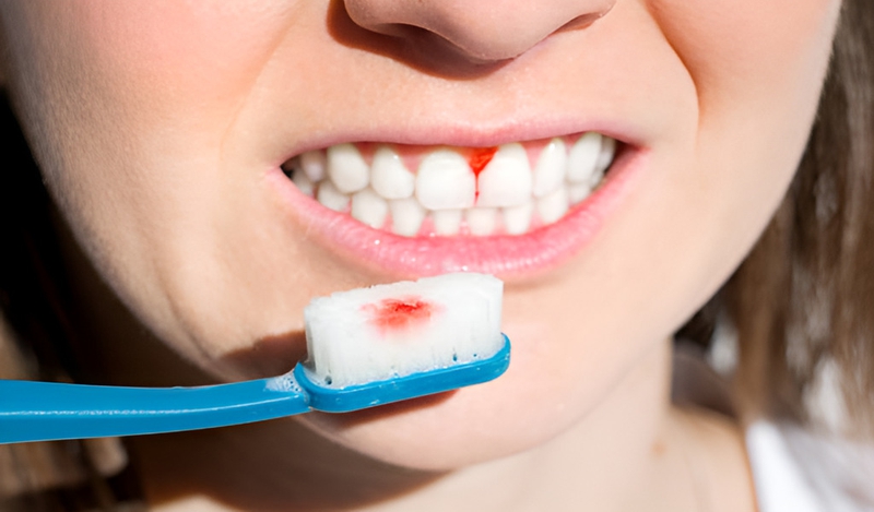 Mách bạn cách chữa chảy máu chân răng đơn giản an toàn và hiệu quả 2