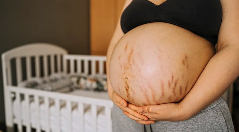 Mách các mẹ cách trị rạn da bụng khi mang thai1