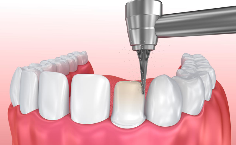 Mài cùi răng ảnh hưởng như thế nào?