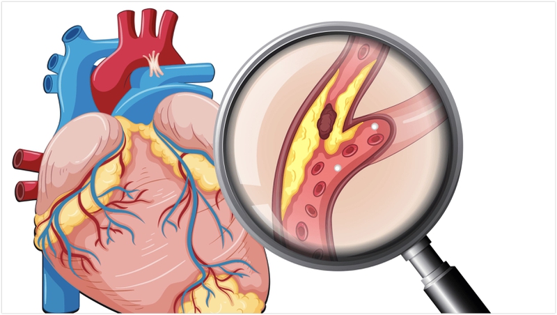 Mảng bám động mạch là gì? 2