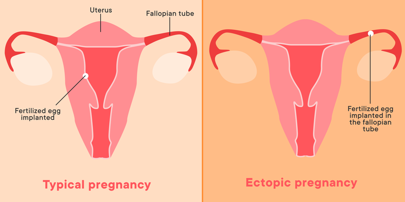 Mang thai ngoài tử cung có kinh nguyệt không - Bạn đã biết chưa? 1