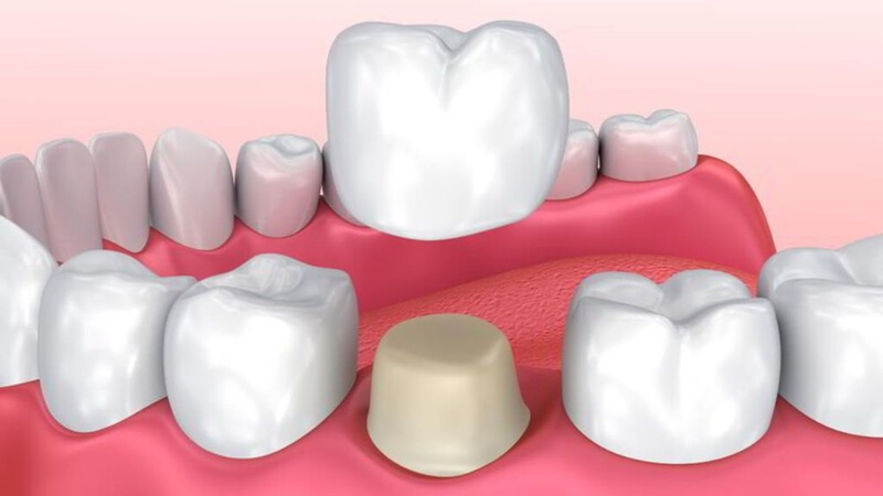 Mão răng sứ: Những thông tin từ A đến Z 1