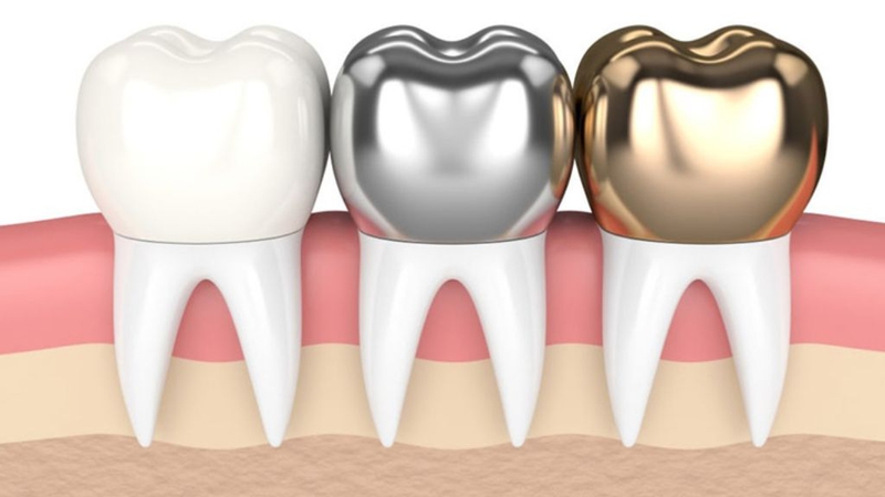 Mão răng sứ: Những thông tin từ A đến Z 2