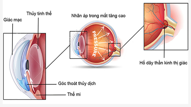 V Rohto nhỏ nhiều sẽ gây tăng nhãn áp? Sự thật và lưu ý khi dùng thuốc nhỏ mắt V Rohto 1