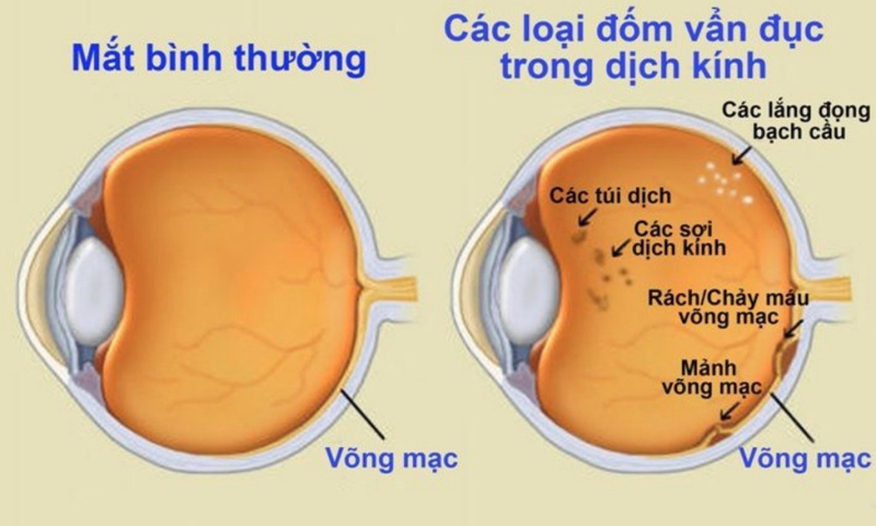 Mắt bị vẩn đục dịch kính: Nguyên nhân, triệu chứng và hướng điều trị 1