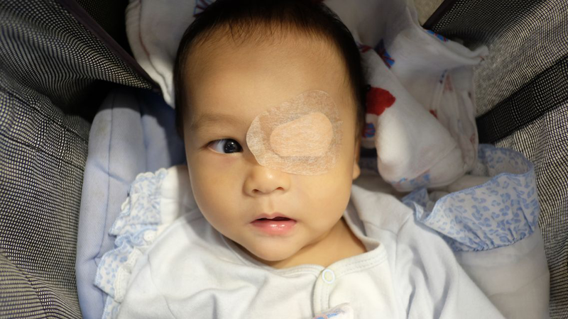 Phẫu thuật chỉnh mắt lé được chỉ định khi các phương pháp khác không hiệu quả