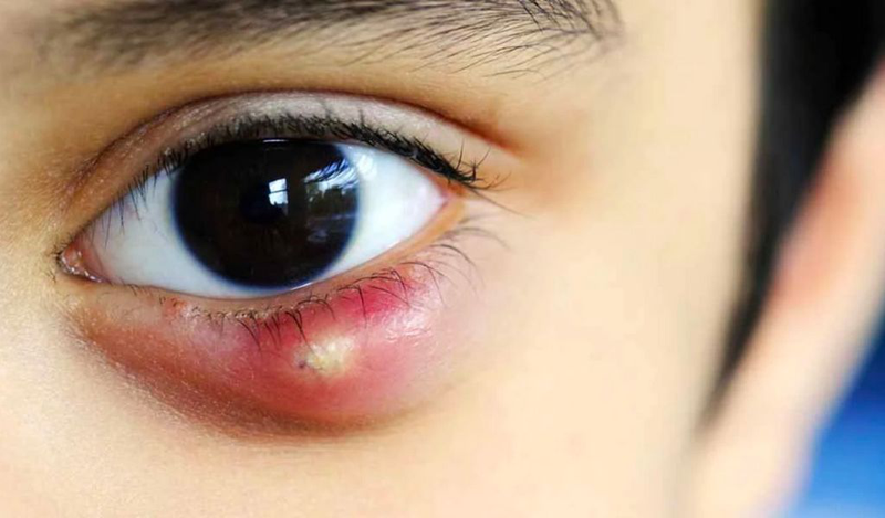 Mắt lẹo là gì? Cách chăm sóc mắt sau khi chích lẹo hiệu quả 1