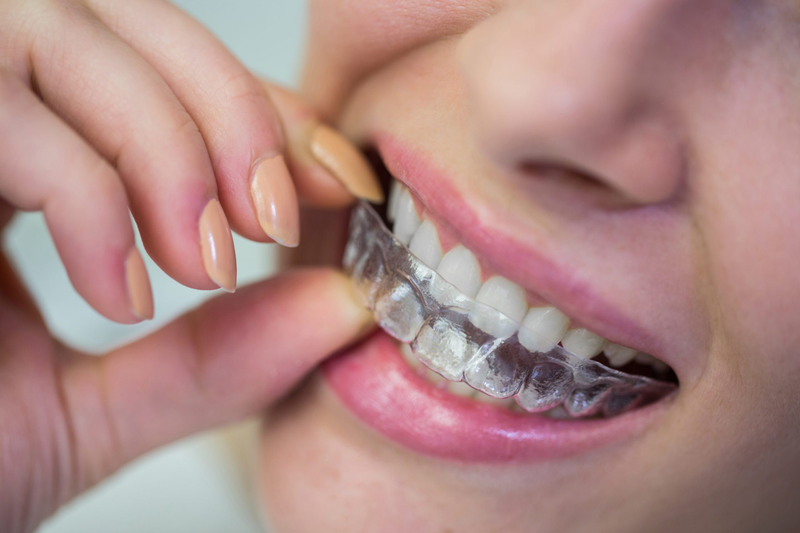 Mất răng có niềng răng được không? Giải pháp tối ưu nhất khi bị mất răng 4