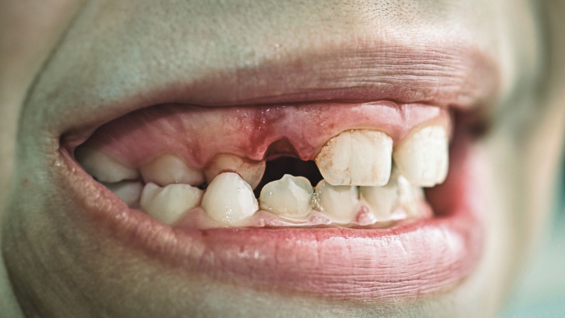 Mất răng số 2: Hậu quả và cách xử lý 1