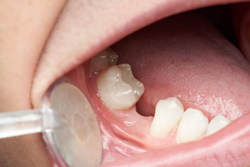 Mất răng số 7 hàm trên gây ra các bệnh lý gì cho răng miệng? 1