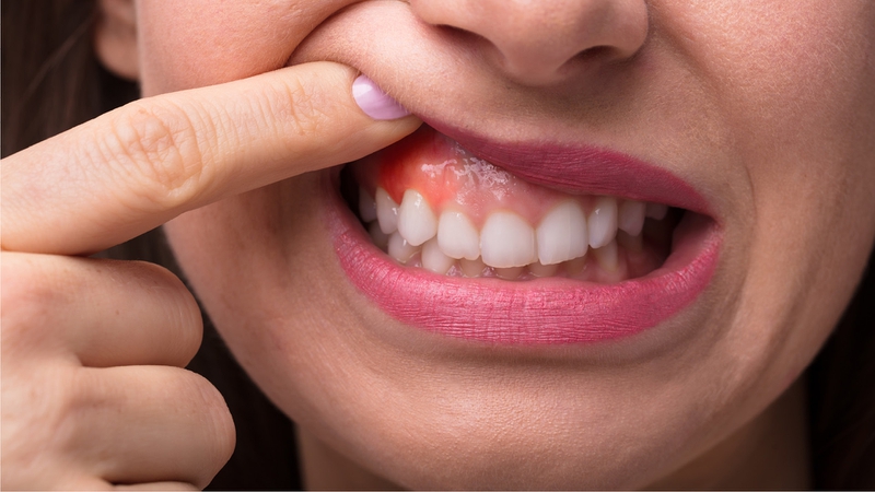 Mất răng số 7 hàm trên gây ra các bệnh lý gì cho răng miệng? 2