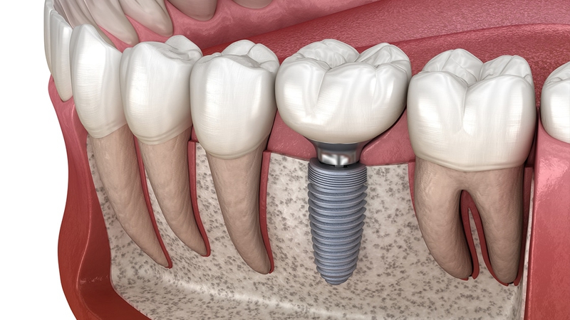 Mất răng số 7 hàm trên gây ra các bệnh lý gì cho răng miệng? 3