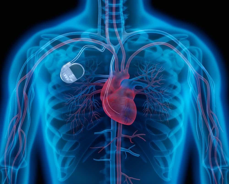 Máy kích tim là gì? Những biến chứng có thể gặp khi đặt máy kích tim 1