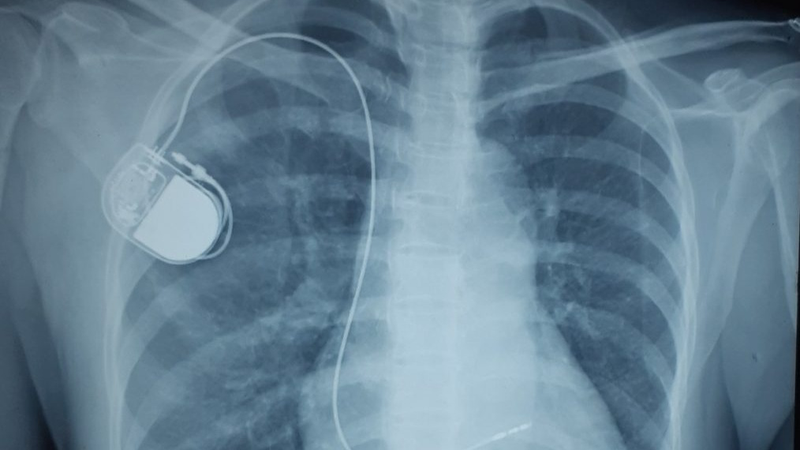 máy tạo nhịp tim tạm thời - Giải pháp lấy lại nhịp tim ổn định 3
