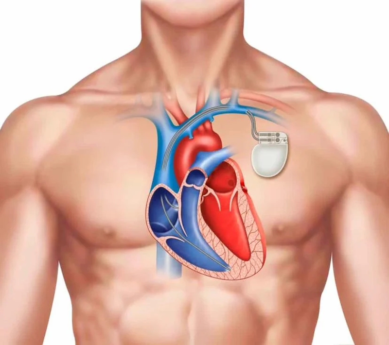 Máy tạo nhịp tim vĩnh viễn: Theo dõi nhịp tim tự động như bác sĩ 3